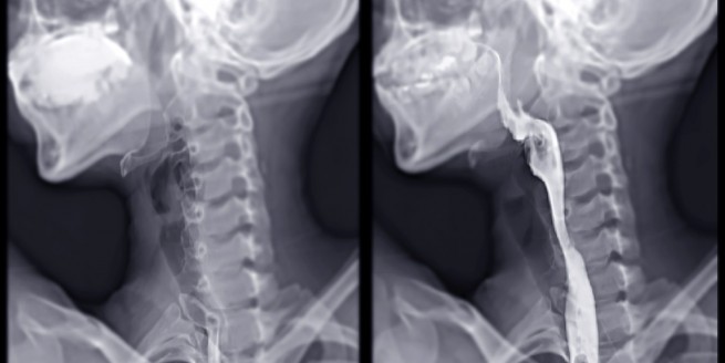 Making the Most of the Modified Barium Swallow image
