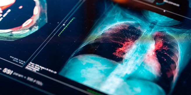 Advocate Health Pulmonary Oncology 2025 Summit: Pathways to Precision image